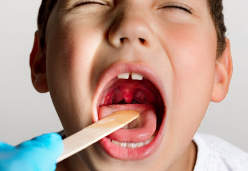 Tonsillitis and Adenoiditis
