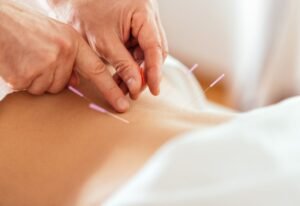 Close-up of dry needling and acupuncture needles inserted into a patient’s lower back