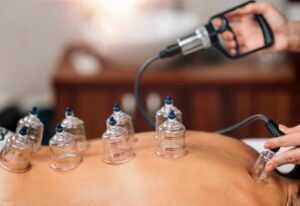Physiotherapist Cupping Therapy